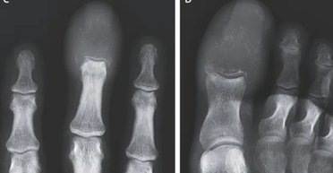 У 55-річного чоловіка набрякли пальці: кістки в них повністю замінив собою рак