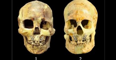 Навіщо стародавні жителі Азії видаляли здорові зуби: вчені знайшли дуже дивну відповідь