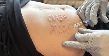 Освобожденный из плена боец ВСУ рассказал, как российский хирург выжег ему на теле "Слава России"