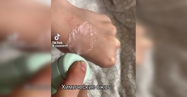 Прожгла руку дезодорантом: 12-летняя девочка повторила опасный тренд в TikTok (фото, видео)