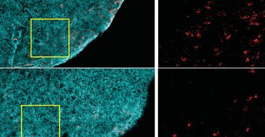 Ожирение улучшает лечение некоторых видов рака, - ученые