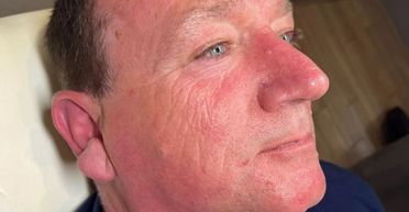 Водій показав, що стало з половиною його обличчя за 30 років "на сонці" (фото)