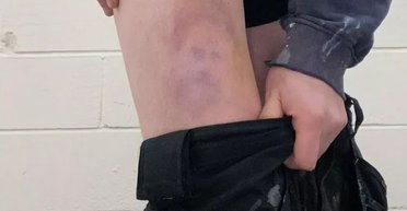 Британский футболист после матча обнаружил у себя синяк в форме лица принца Гарри