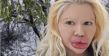 Дівчина з "найбільшими губами у світі" подарує собі на Різдво нові філери (фото)