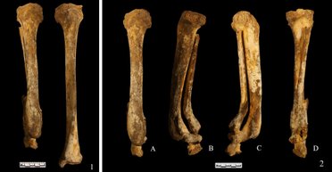 Почти 3000 лет. Археологи нашли свидетельства самой старой ампутации стопы в мире