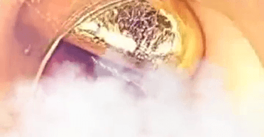 У шлунку 11-річного хлопчика знайшли золотий злиток: як це можливо (фото)