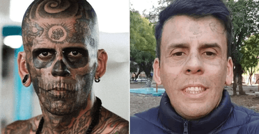 Чоловік із 95% тіла в татуюваннях здивував світ після видалення малюнків (відео)