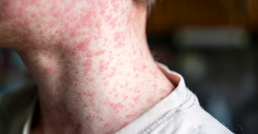 Спалах кору зафіксовано в Україні: де найвищі показники захворюваності