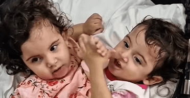 Сіамських близнюків дивом розділили: для цього знадобились зусилля 16 лікарів (фото)