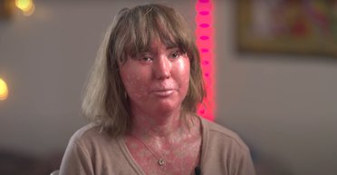 Похожа на чешуйчатую змею: женщину с редким заболеванием буллили, но она смогла это пережить (фото)