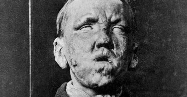 У Флориді зростає кількість випадків "божої кари": дедалі більше людей заражаються проказою