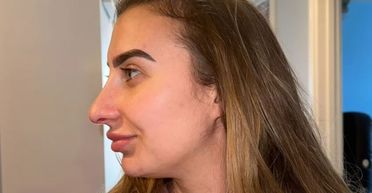 Жінка заплатила $14 тисяч за корекцію носа: схоже, пластичний хірург її "не так почув" (фото)