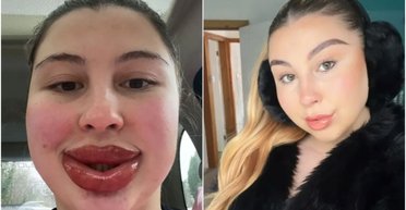 "Стала монстром": жінка поскаржилась, що її губи весь час збільшуються (фото)