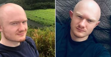 Чоловік покоління Z рано облисів, а потім з ним сталося "справжнє диво" (фото)