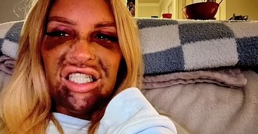 Зубные импланты сделали меня чудовищем: модель рассказала о своем ужасном опыте (фото)