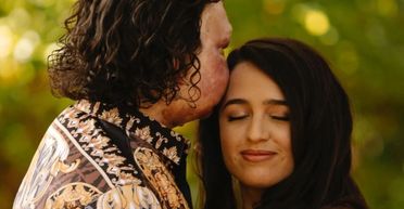 Чоловік з "пересадженим" обличчям одружується: який вигляд має його обраниця (фото)