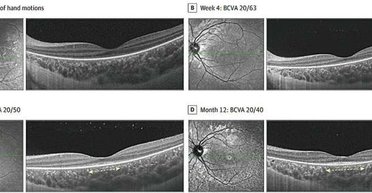 Неизвестная болезнь из Китая вызывает детскую слепоту: что известно