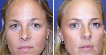 Одна из близняшек колола ботокс в течение 20 лет, а другая — нет: кто из них сейчас выглядит лучше