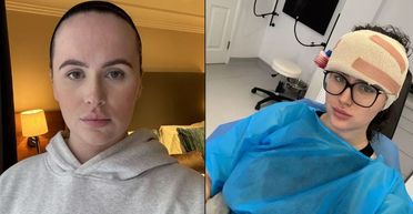 "Обзивали п'ятиголовою": жінка віддала майже пів мільйона гривень, щоб зменшити своє чоло (фото)