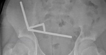 Підліток проковтнув майже 200 небезпечних магнітів: вижив, але позбувся частини кишківника (фото)