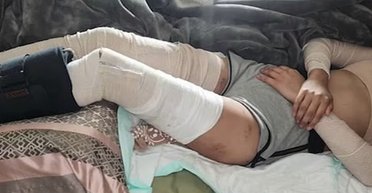 Девочка во время пробежки подверглась нападению более 10 собак: ее первый вопрос поразил всех (фото)