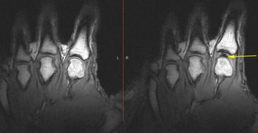 Феєрверки в суглобах: що насправді відбувається з пальцями, коли ними хрустять (відео)