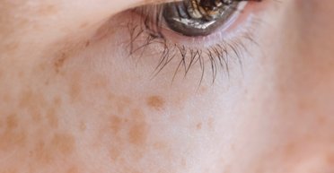 Пігментні плями звідки беруться та як позбутися в домашніх умовах