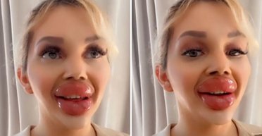 Так "наколола", что не может есть: девушка с самыми большими губами нацелилась на новый рекорд (фото)