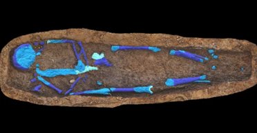 Редкий "фарфоровый желчный пузырь" найден в 100-летней безымянной могиле (фото)