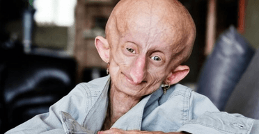 Надихала мільйони: померла дівчина, яка старіє у вісім разів швидше (фото)