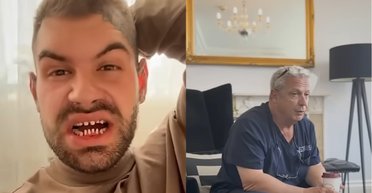 "Турецькі зуби" позбавляють усмішки: стоматолог розповів те, про що мовчать пацієнтам (відео)