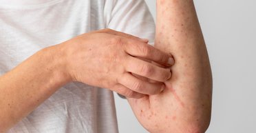 Інфікуються 9 з 10 невакцинованих людей: у МОЗ розповіли про небезпеку кору