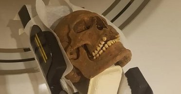 Вікінги страждали від жахливих хвороб: що з'ясували вчені