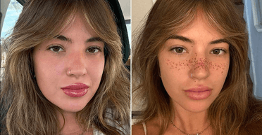 "Намалювали маркером": дівчина показала "невдале" тату веснянок на обличчі (відео)