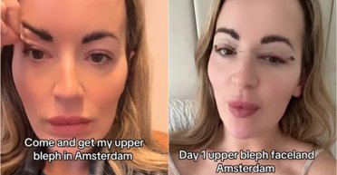 Жінка зробила пластичну операцію, щоб підняти опущені повіки: що в неї вийшло