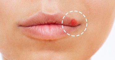 Герпес зможе вилікувати людей від важкого раку шкіри: випробування на фінальній стадії