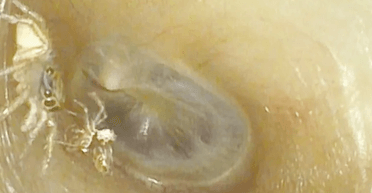 Почала чути "ненормальні" звуки: павук скинув стару шкіру у вусі жінки (відео)