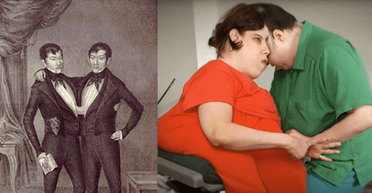 Рождаются примерно раз на 50-60 тысяч родов: известные истории сиамских близнецов (фото, видео)