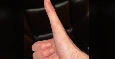 Чоловік із аномально довгим великим пальцем розповів про щоденні труднощі (відео)