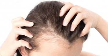 Каждый в группе риска. Ученые назвали самую распространенную причину облысения