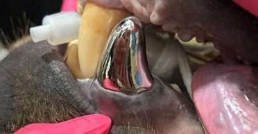 "Уперше в історії": який вигляд має найбільша зубна коронка у світі та кому її поставили (фото, відео)