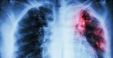 Страшный диагноз. Почему туберкулез вылечить легче, чем связанные с ним стереотипы