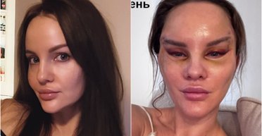 Россиянка обиделась на земляков, которые высмеивают ее неудачную пластическую операцию