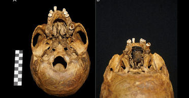 Помогал глотать, дышать и разговаривать: археологи обнаружили 300-летний протез неба (фото)