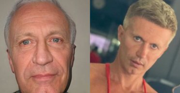 Помолодшав на 40 років: чоловік змінився до невпізнання після операції в Туреччині (фото)