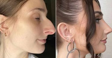 Жінка розлучилась з чоловіком після пластичної операції: який вигляд вона має зараз (фото)