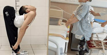 Ламали кістки: "складений хлопчик" із Китаю вперше в житті зміг лягти рівно (відео)