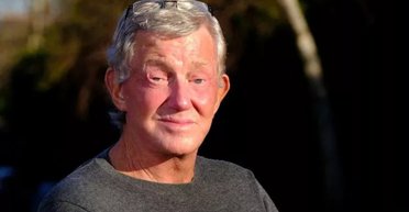 "Гидко дивитися": пенсіонер 4 роки не міг зімкнути очі після невдалої операції (фото)