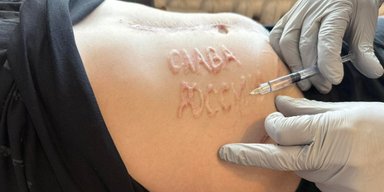 Звільнений з полону боєць ЗСУ розповів, як російський хірург випалив йому на тілі "Слава Росії"