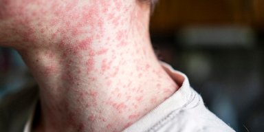 Вспышка кори зафиксирована в Украине: где наивысшие показатели заболеваемости